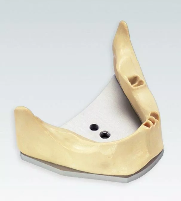 A-J KA Стоматологическая модель беззубой нижней челюсти для имплантации  с монтажной пластиной