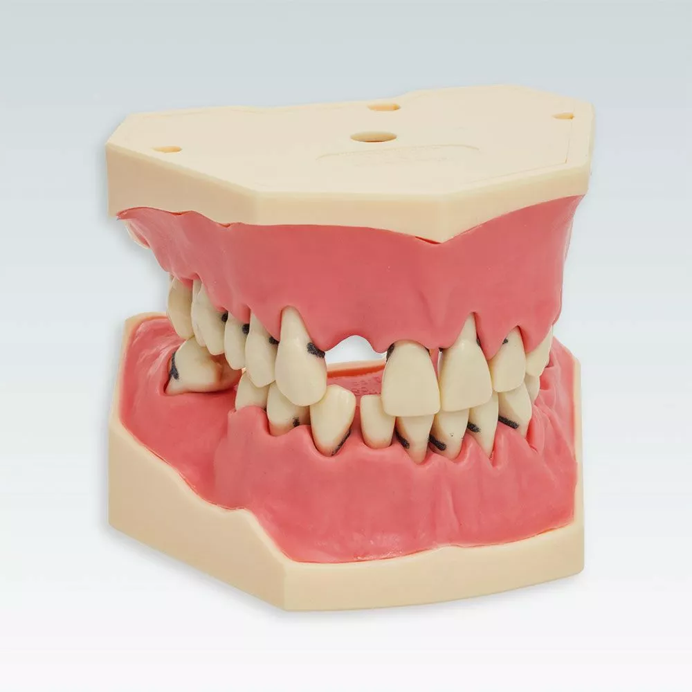 A-PB Стоматологическая модель верхней и нижней челюсти с выраженным пародонтитом