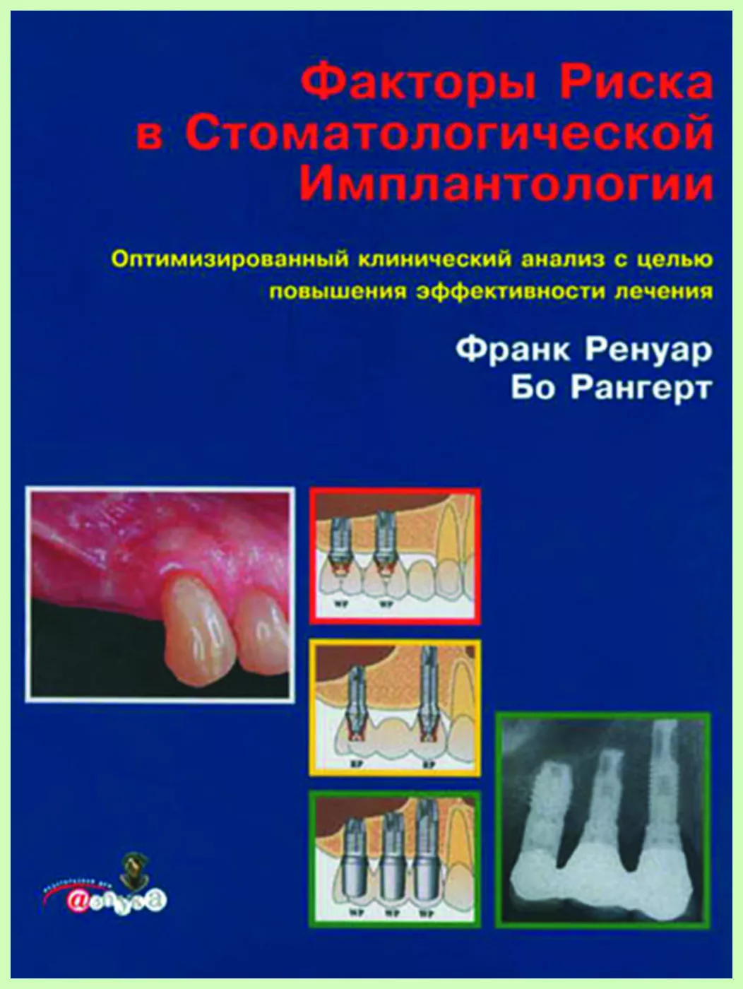Книга "Факторы риска в стоматологической имплантологии" / Ф. Ренуар