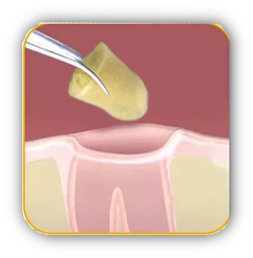 Микротупферы стоматологические коллагеновые 10