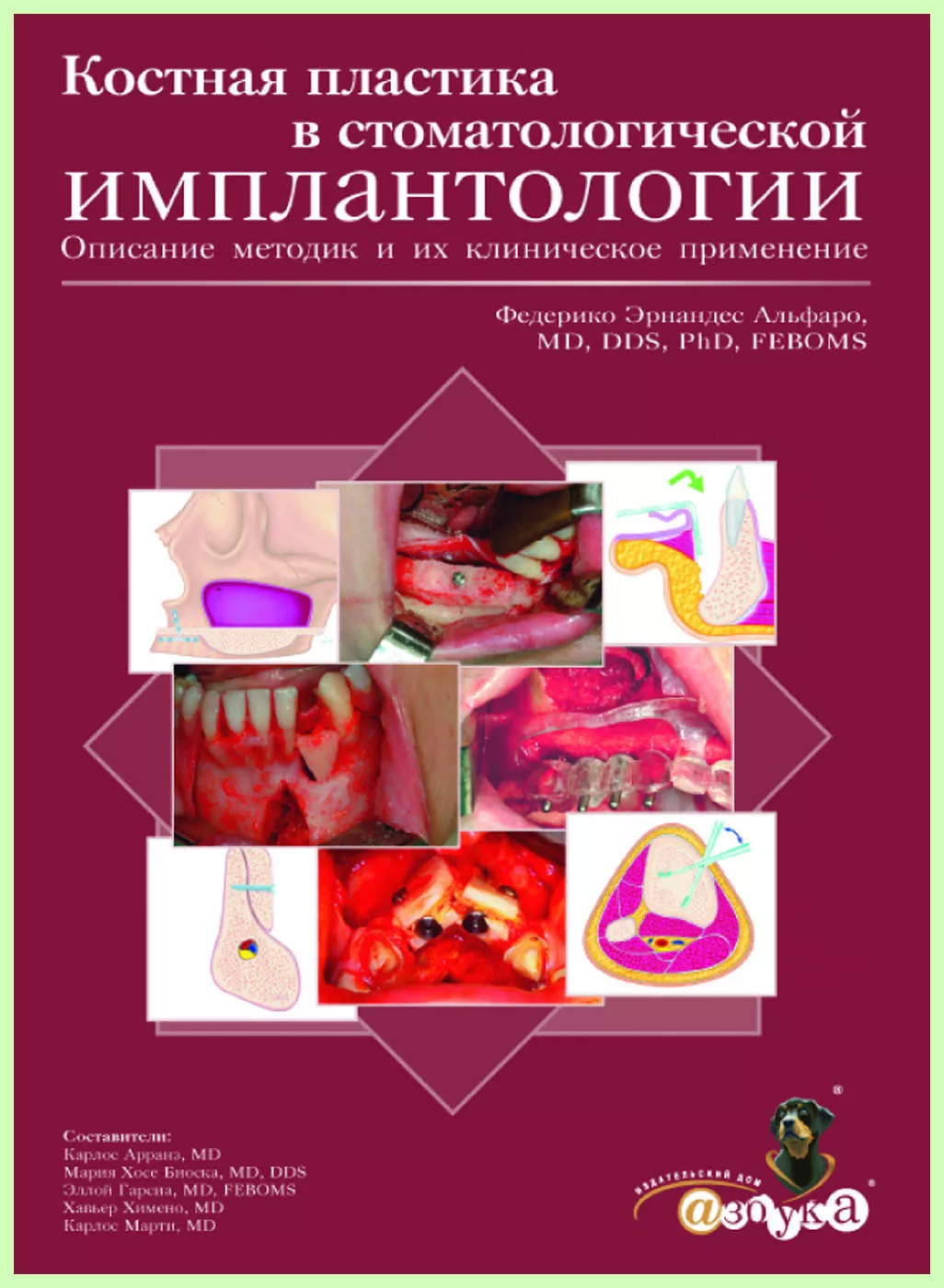 Костная пластика в стоматологической имплантологии / Ф. Альфаро