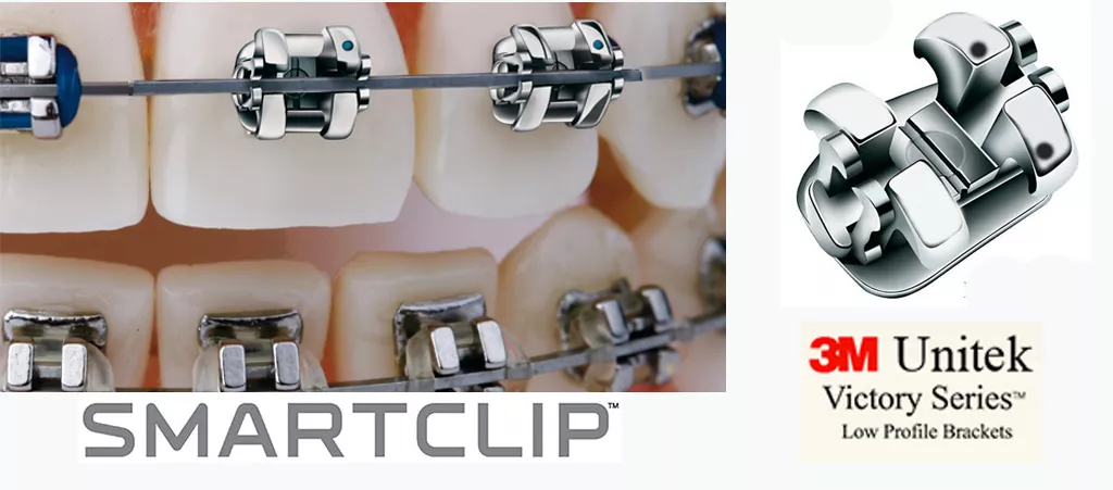 Брекет металлический самолигирующийся SmartClip MBT .022 LR3 с крючком (3M)